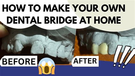 diy maryland dental bridge